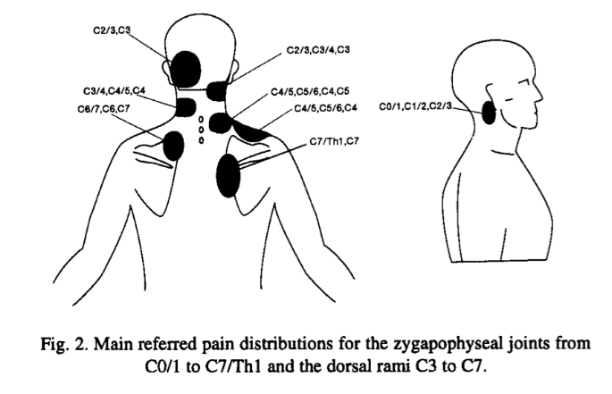 Dolor referido facetario, Bogduk 1996