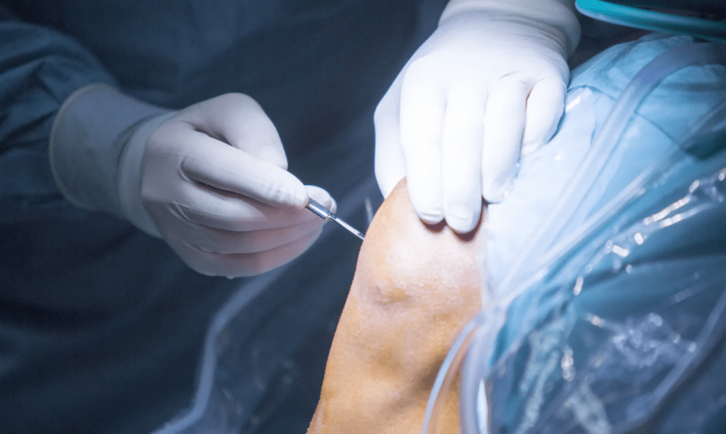 Boicot al ligamento cruzado anterior: Tibial Slope.